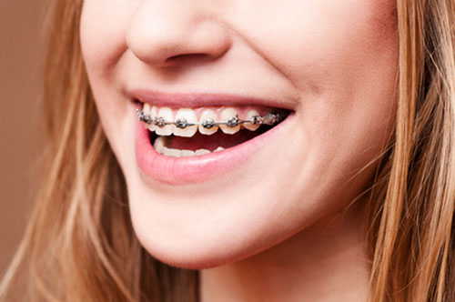 Discovering the Benefits of Metal Braces for a Brighter Smile